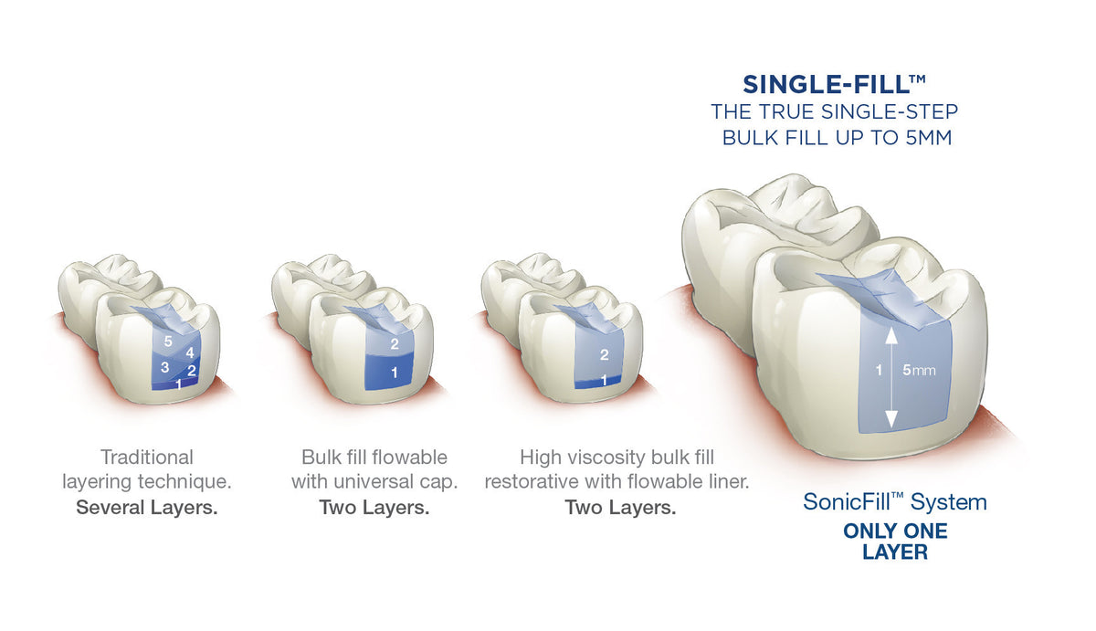 SonicFill 3 single-fill bulk fill up to 5 mm diagram