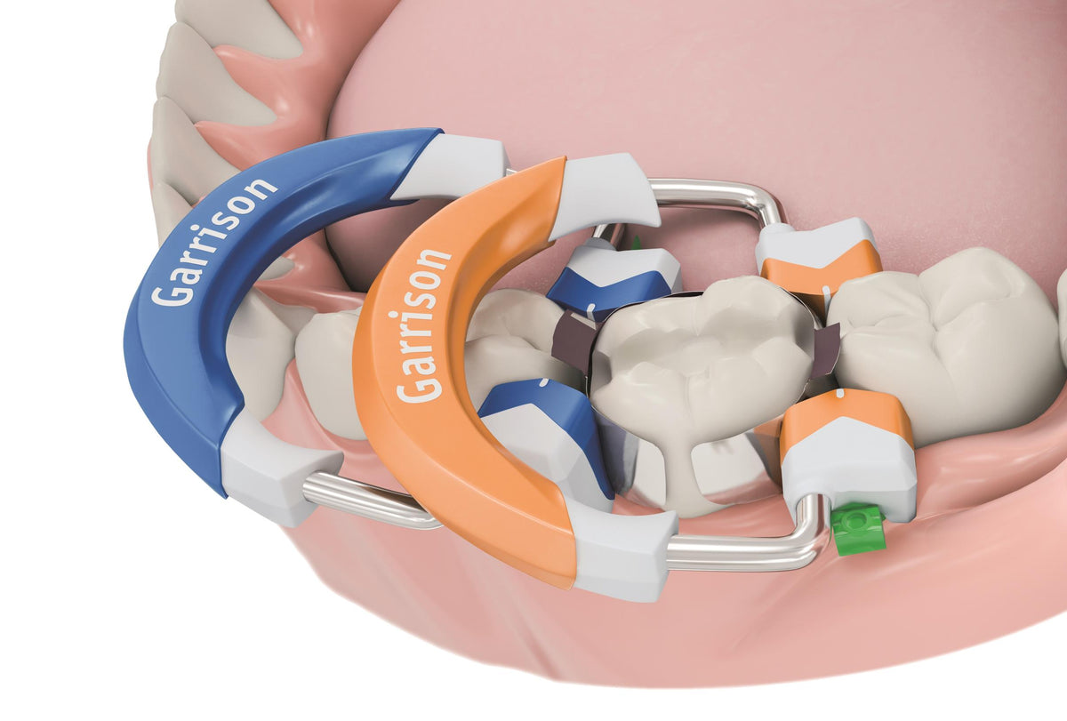 Composi-Tight 3D Fusion rings stacked for an MOD restoration