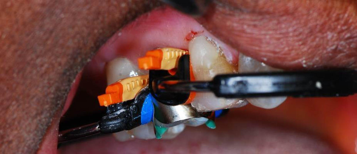 Composi-Tight 3D Fusion wedge in use