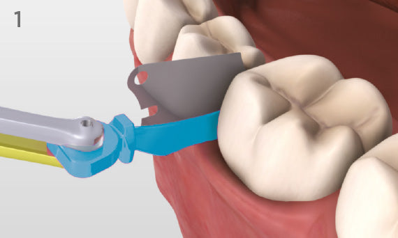WedgeGuard placed between teeth before preparation (570 px graphic)