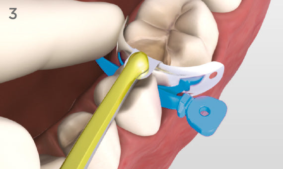 Palodent Plus wedge placed interproximally (570 px graphic)