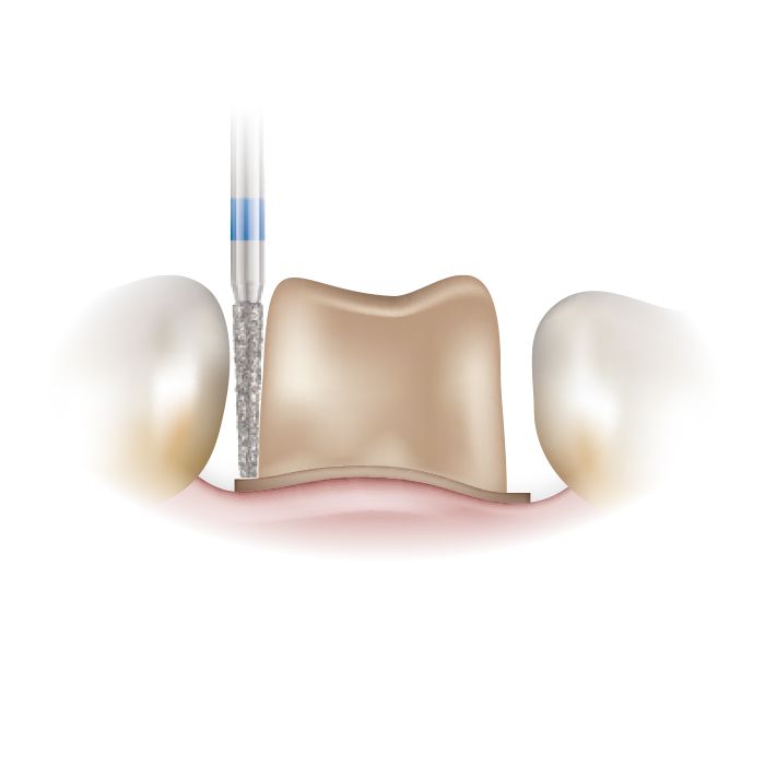 Illustration of a flat end taper diamond bur preparing a crown margin