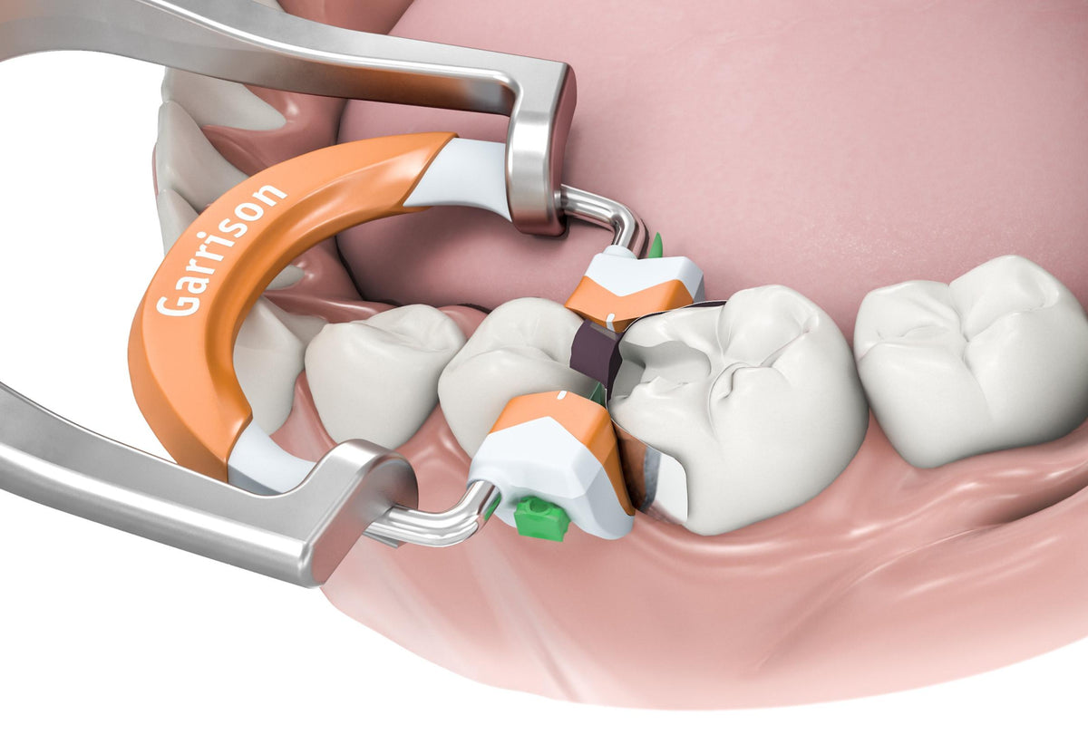 Composi-Tight 3D Fusion ring in use on a matrix band
