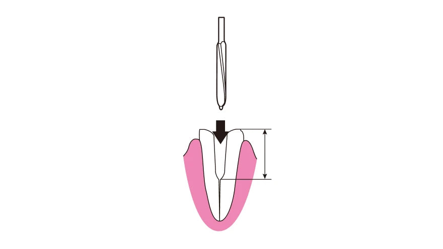 Peeso reamer widening the canal orifice
