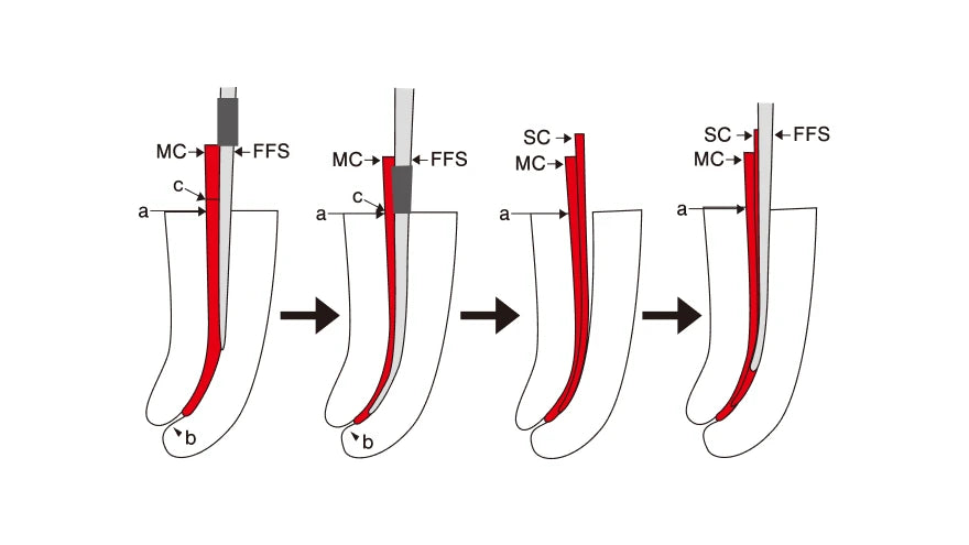 Lateral condensation steps with a MANI flare finger spreader