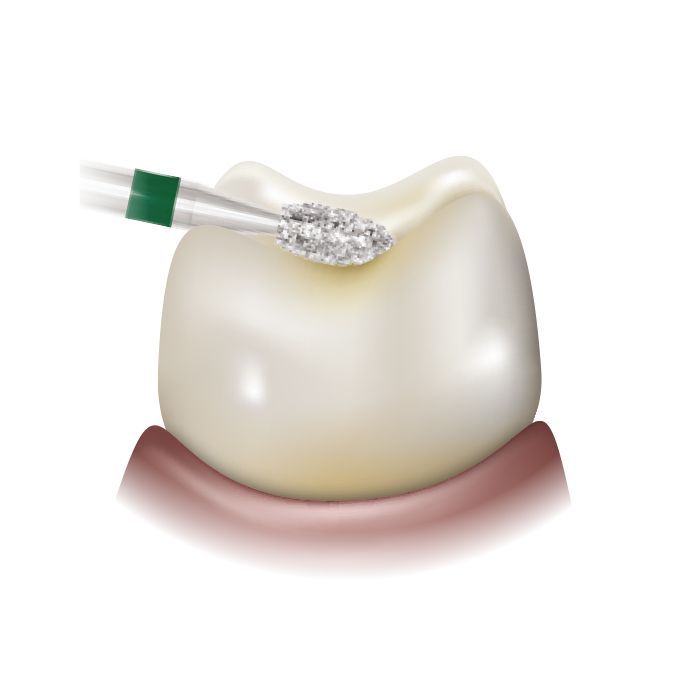 Illustration of a football diamond bur shaping a molar