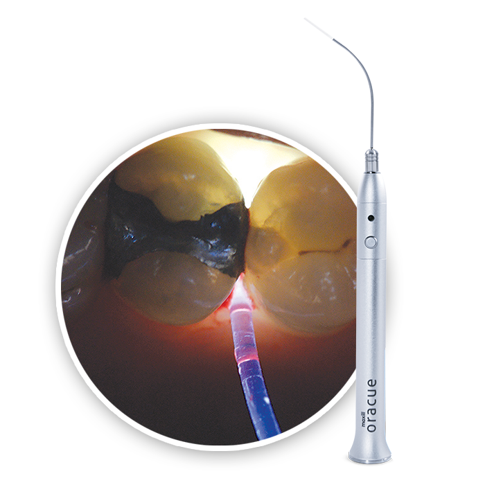 oracue LED Examination Penlight with an endo guide and fiber lighting a tooth