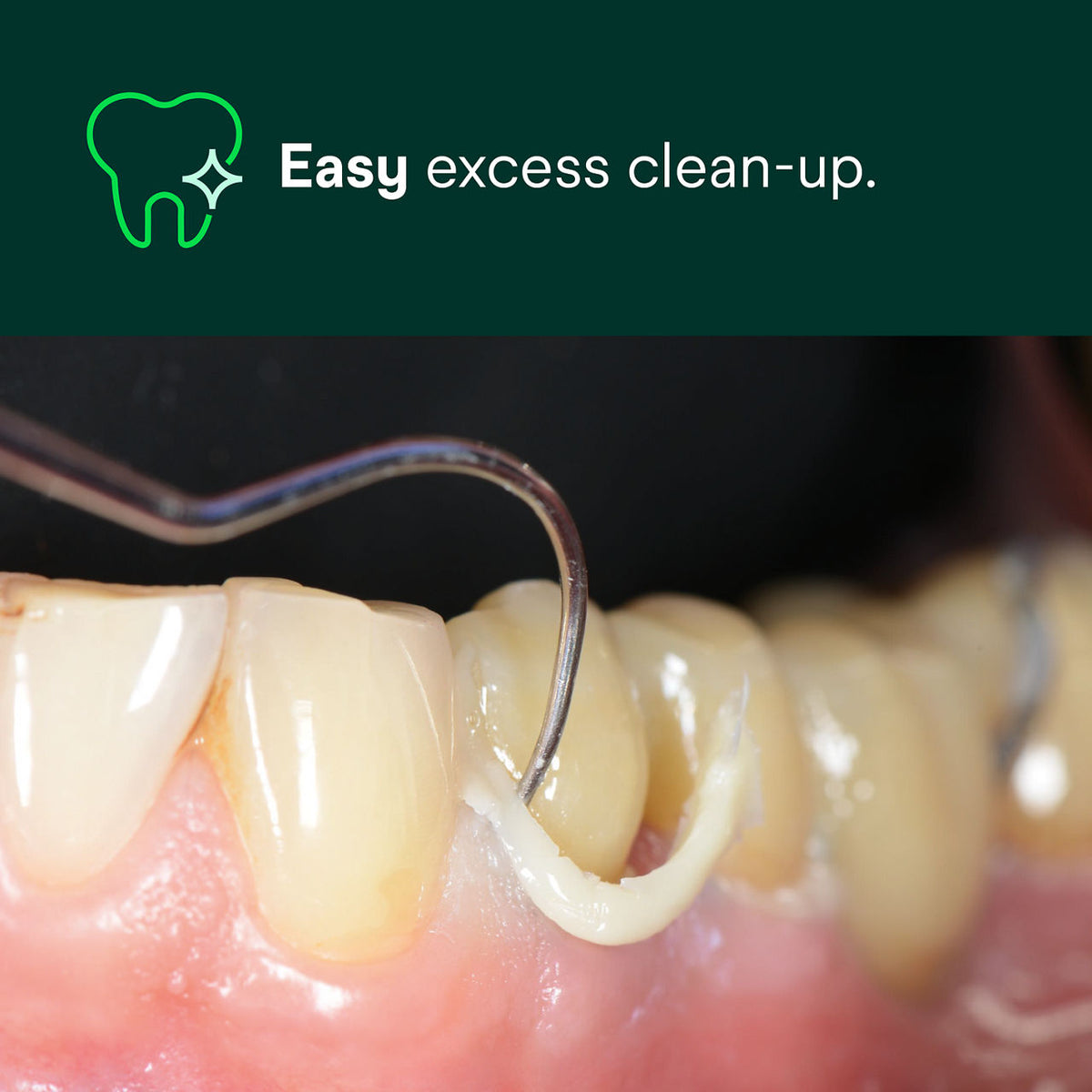 RelyX Universal Resin Cement easy excess clean-up after tack cure