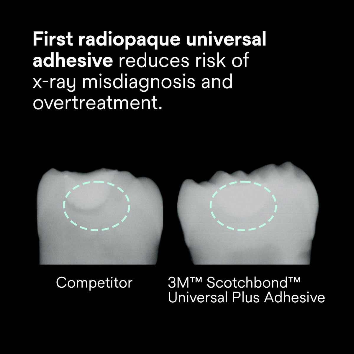First universal adhesive with dentin-like radiopacity