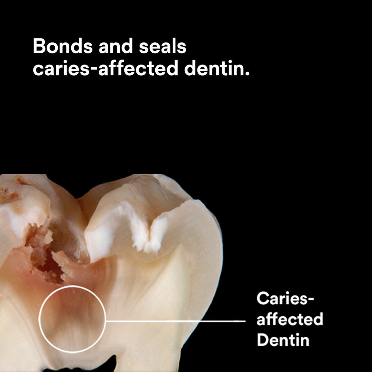 Scotchbond Universal Plus Adhesive bonding to caries-affected dentin